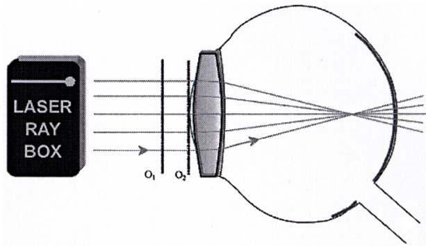 E22b Modello di occhio miope (, pellicola A) I fasci luminosi paralleli all'asse ottico vengono interrotti dalla lente dell'occhio e si incontrano in un punto davanti alla retina.