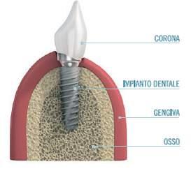 osso Il metodo più avanzato e al tempo stesso più naturale per la sostituzione di un dente è rappresentato dall inserimento di un impianto dentale.