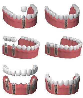 Il trattamento implantare In seguito ad un accurata diagnosi e ad una scrupolosa pianificazione del trattamento, gli impianti dentali vengono inseriti in osso mascellare/mandibolare con un intervento