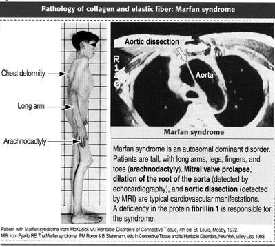 Sindrome di Marfan: alterazione della fibrillina (fibre elastiche) che porta ad una