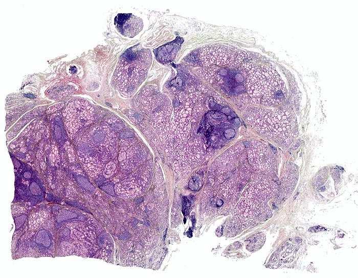 Tiroidite di Hashimoto Fibrosi Tiroidite di Hashimoto La malattia ha tre varianti: 1.