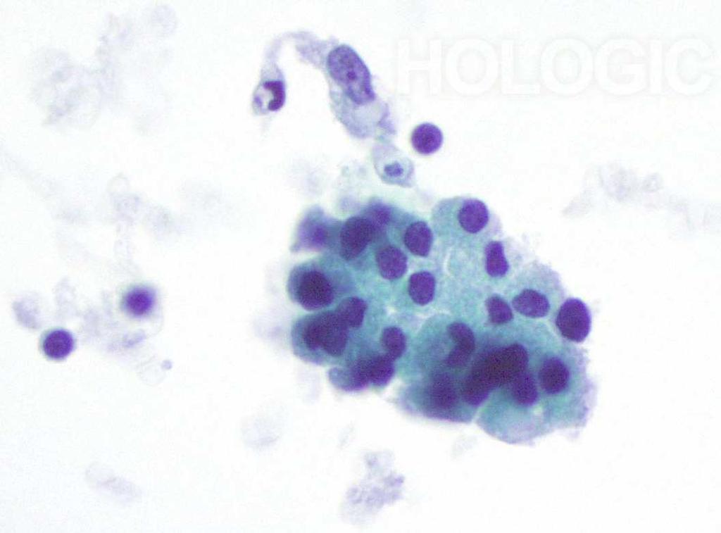 30/03/2016 Tiroidite di Hashimoto: citologia il follicolo linfoide con cellule linfoidi in varie fasi di maturazione follicolo
