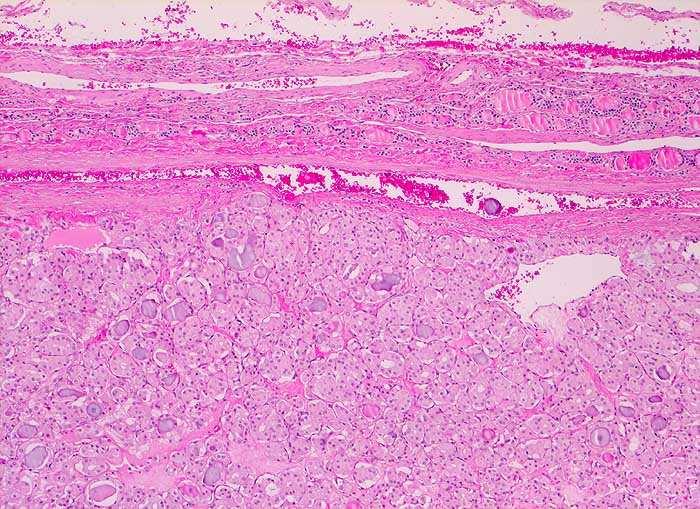 Adenoma follicolare Variante a cellule di Hurtle: cellule con ampio citoplasma