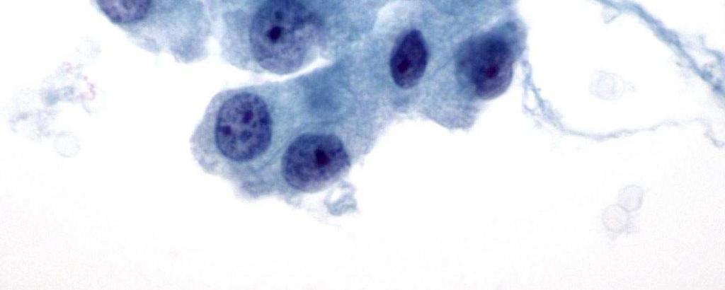 invasione vascolare. Neoplasia a cellule di Hürthle.