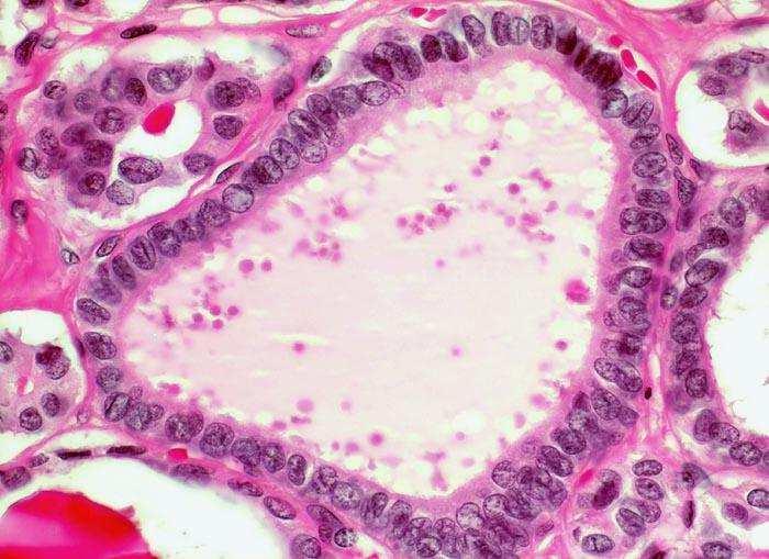 Carcinoma papillare Caratteristiche nucleari Nuclei grandi, sovrapposti, con