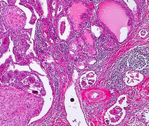 30/03/2016 Carcinoma papillare Varianti Variante a cellule colonnari/alte: Variante follicolare: con caratteristiche nucleari tipiche del carcinoma papillare, ma con architettura follicolare.