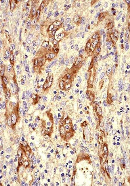 Tumori rari Angiosarcoma tiroideo Cellule endoteliali positive per Fattore VII È un