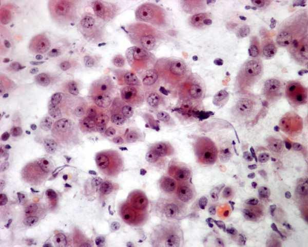 Neoplasie metastatiche Nel 10% delle autopsie di pazienti morti per neoplasia maligna si riscontrano metastasi tiroidee Sedi più frequenti: Melanoma (33%) Mammella (21%) Rene (12%) Polmone (11%) The