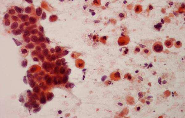 The thyroid needle aspirate in patient 4 shows single and loosely clustered polygonal cells with abundant, granular cytoplasm and eccentrically located oval nuclei with prominent nucleoli, suggesting
