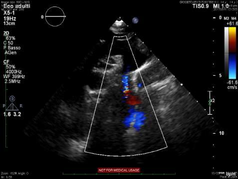 CasisLca CardiopaLa nel bambino: esempio (Gr) Ø Riscontro