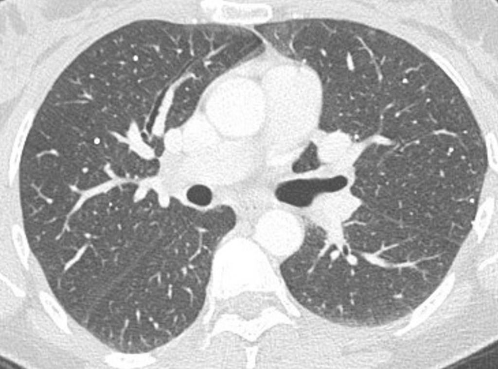 Varicella Infiltrato infiammatorio interstiziale, essudato