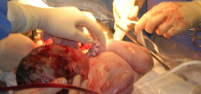 9: Clampaggio e recisione del funicolo Dopo l allontanamento del neonato, l ostetrica che indossa guanti sterili procederà ad una accurata disinfezione a monte della seconda clamp.