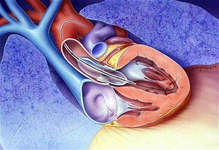 Balloon Aortic Valvuloplasty (BAV) Nata negli anni ottanta per le stenosi congenite nei bambini (Lababidi 1984) Utilizzata successivamente negli adulti con SA severa ed elevato rischio
