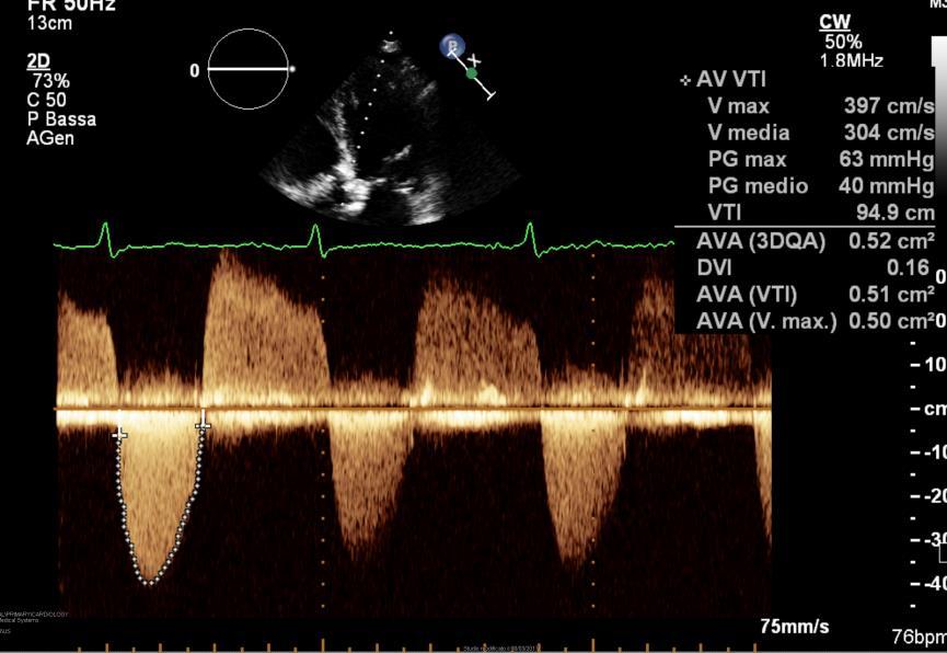 L.G, donna di 82 anni CASO CLINICO Diabete tipo 2, ipertensione arteriosa, IRC in trattamento dialitico