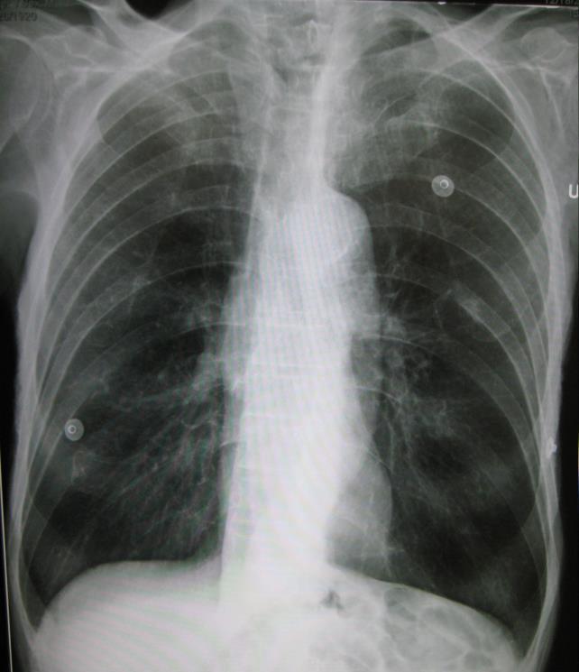 pneumopatie ostruttive Morfologia -Aumento