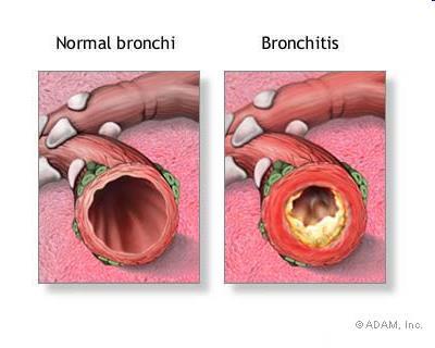 pneumopatie ostruttive tosse persistente con espettorato con durata di almeno tre mesi per due anni consecutivi Clinica Patogenesi -Irritazione -Ipersecrezione -Aumento goblet cells bronchioli