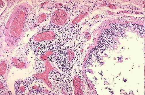 pneumopatie ostruttive Morfologia -Iperemia e edema mucosa -Secrezione