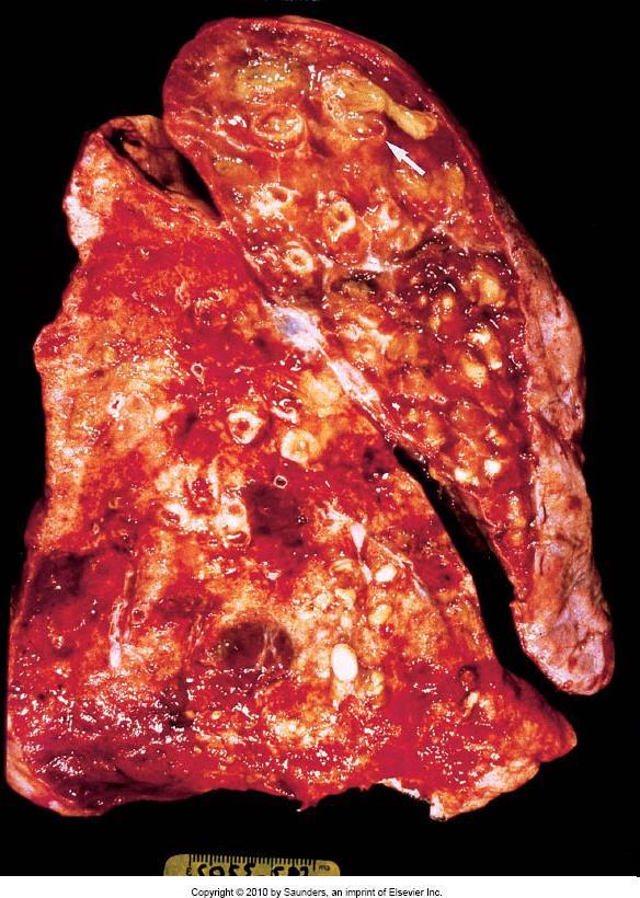 pneumopatie ostruttive Morfologia -Localizzazione ai lobi inferiori -Interessamento di bronchi distali e bronchioli -Dilatazione del lume bronchiale (<= 4 volte) -Localizz.