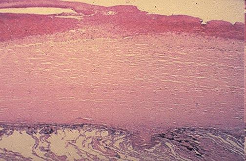 Morfologia pneumopatie restrittive -Pleura con aspetto a ciottolato (retrazioni fibrose sottostanti) -Fibrosi lungo i setti interlobulari -Aree