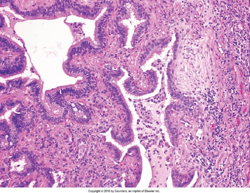 pneumopatie restrittive Morfologia -Pattern cellulare:.