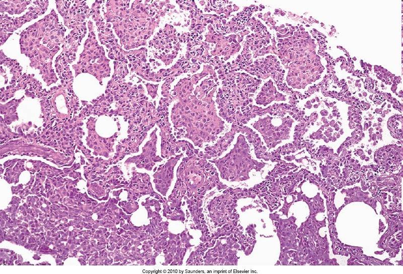 Morfologia -Accumulo alveolare macrofagi (pigmentati) -Inclusioni di surfattante nei macrofagi -Ispessimento