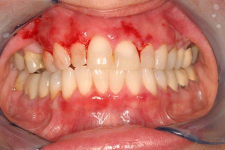 Correlazioni anatomo-cliniche cavo orale: Lesioni di dimensioni ridotte
