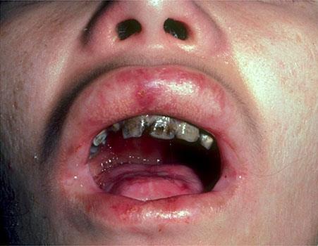 Correlazioni anatomo-cliniche cavo orale: F. bollosa simplex Occasionale local. orale delle bolle Denti indenni Distruzione strato basale e soprabasale F.