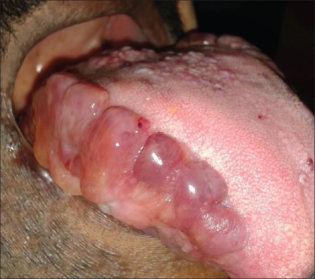 Correlazioni anatomo-cliniche cavo orale: Depositi amiloidei linguali (sottomucosi e muscolari); macroglossia (A.