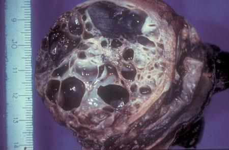 Classificazione istologica Carcinoma Embrionario (20-25%) NON SEMINOMI Altamente maligno Raro nella forma pura, nel 70-80% dei casi rappresenta una delle componenti delle forme miste 2/3 dei casi