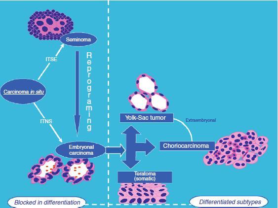 CARCINOMA IN SITU (CIS) - NEOPLASIA A CELL GERMINALI INTRATUBULARE INDIFFERENZIATA (ITGCNU) Stadio premaligno nello sviluppo di tutti i tipi istologici di carcinoma testicolare ad eccezione del