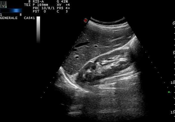 Risposta: 1 + 3 + 5 Screening Celiachia: IgA Totali normali, Anti Transglutaminasi IgA negative Eco addome: ndn (Fegato regolare per volume con ecostruttura indenne da focalità sospette.