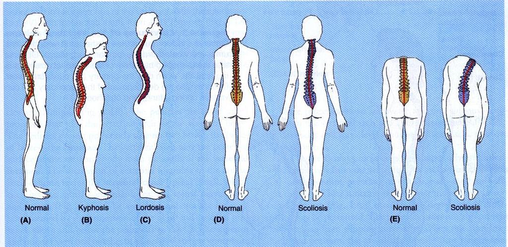 Curve anomale della Colonna Vertebrale profilo laterale profilo dorsale Congenite