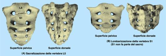 Sacralizzazione e Lombarizzazione In alcuni soggetti L5 è parzialmente o completamente fusa con l osso sacro Emisacralizzazione o