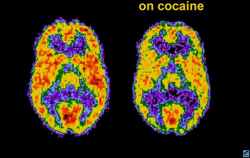 Normale Cocainomane Positron emission