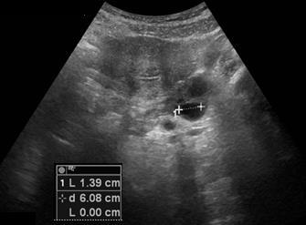 responsabile di stop del mdc, sospetta per ripresa di malattia endometriosica (figure 3-5).