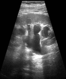 Urologia per il posizionamento di uno stent ureterale sinistro a doppio J sotto guida cistoscopica.