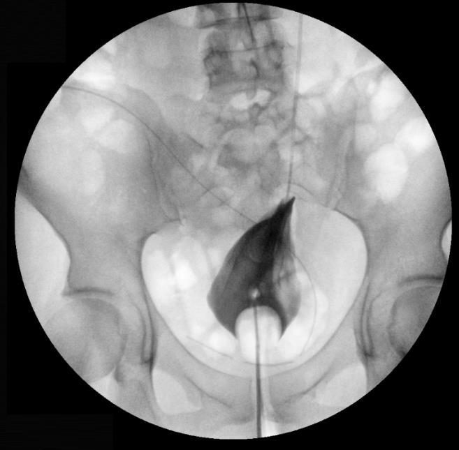 ureteroneocistostomia con Psoas-Hitch in assenza di stravaso extravescicale.