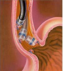 Procedure gastroenterologiche Legatura di