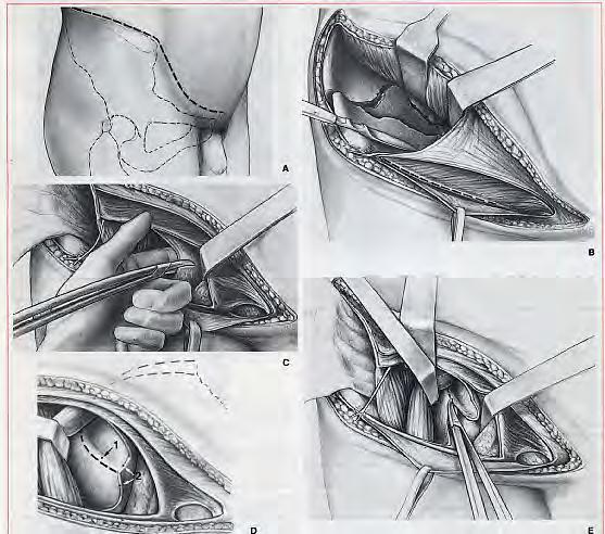 Ilioinguinal Standard approach for