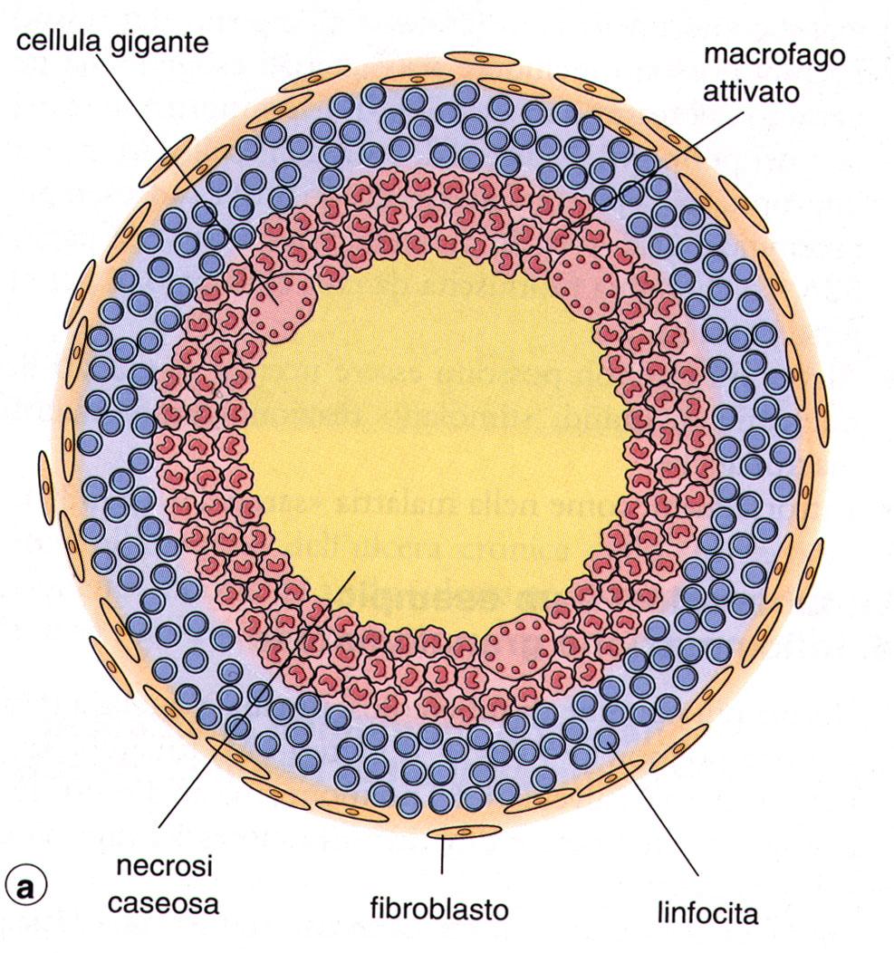 Focolaio di infiammazione cronica costituito da un aggregato microscopico di macrofagi, morfologicamente trasformati in cellule epitelioidi, circondato da leucociti mononucleati, soprattutto