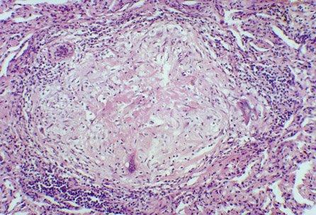 Mycobacterium tuberculosis