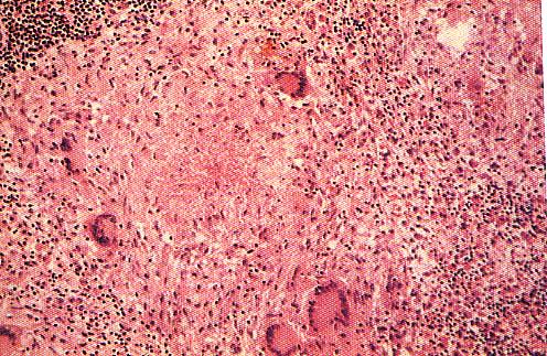 TUBERCOLO linfociti Tessuto