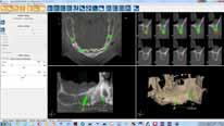 guidata, capaci quindi di pianificare CAD il caso clinico sulla base delle indicazioni fornite loro dal dentista stesso (numero e posizione