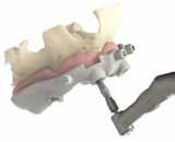osso Inserimento preparatore di spalla ESPS Creazione svasatura