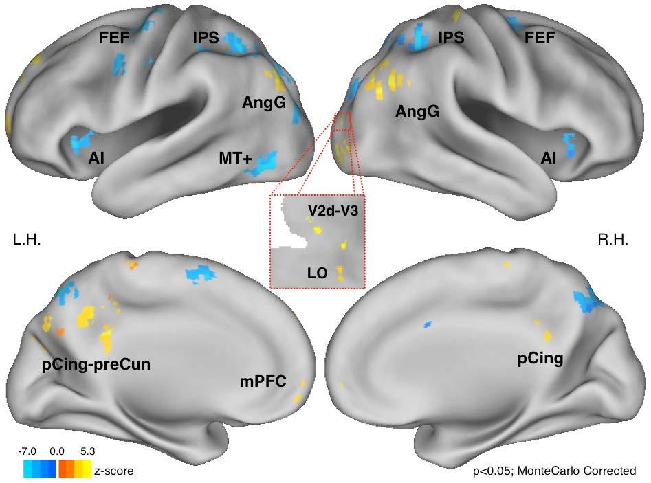 2.fMRI/B.Learning-Activity/2.Tutto il Cervello Forma Allenata (T rovesciata) vs. Non-Allenata (T dx, T sx) 1. Maggior Attivazione Forma Allenata vs.