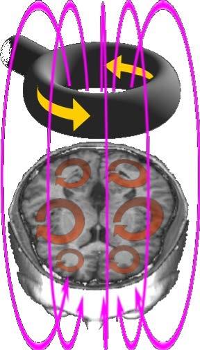 Stimolazione Magnetica Transcranica Negli studi di TMS, la bobina stimolante, racchiusa in plastica, si tiene sopra la testa di un soggetto.