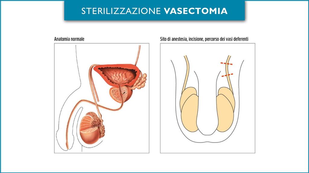 INTERVENTO DI vasectomia consenso informato La vasectomia è l intervento chirurgico che porta all interruzione dei dotto deferenti, che sono i tubicini all interno dei quali gli spermatozoi partendo