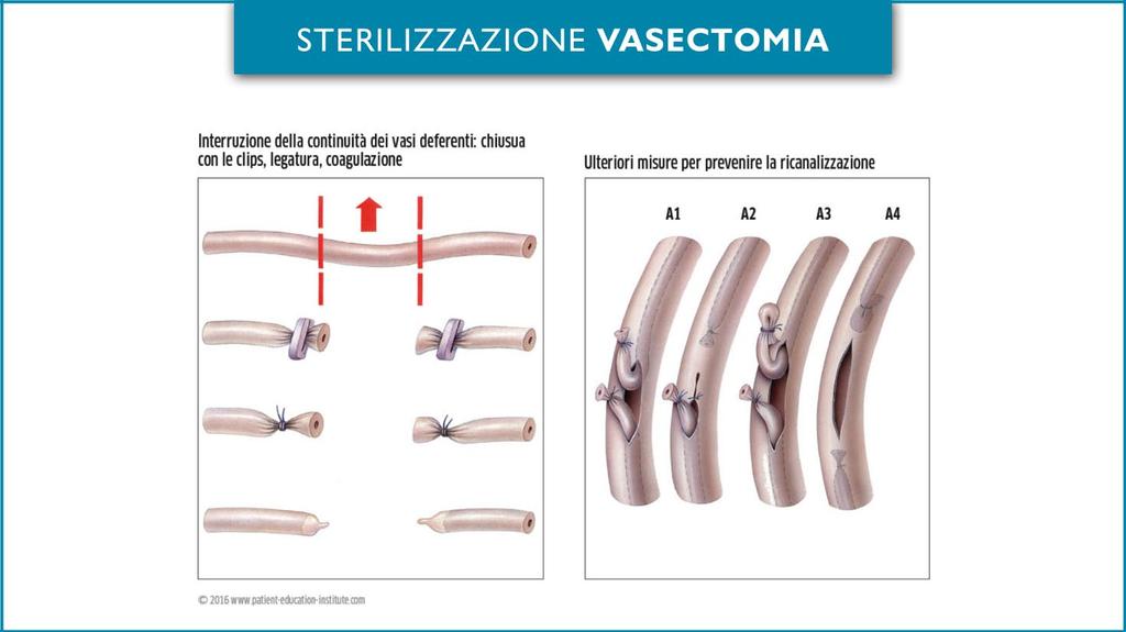 vasectomia: TECNICA chirurgica L intervento viene eseguito in anestesia locale e richiede due piccole incisioni chirurgiche a livello di ciascun emiscroto interessato.