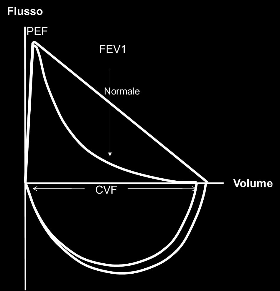 Le malattie respiratorie ostruttive generano curve concave.