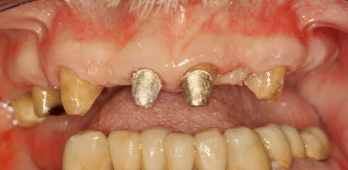 recupero della radice mediante estrusione ortodontica.